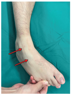 JaypeeJournals's tweet photo. Identification of the #SuperficialPeronealNerve: Is the Ankle Plantar Flexion #FourthToeFlexionSign Useful in a SouthEast Asian Population? https://t.co/JFtGWSyHOo #YuetPengKhor #DrMandeepSDhillon https://t.co/toVVnnPGRE