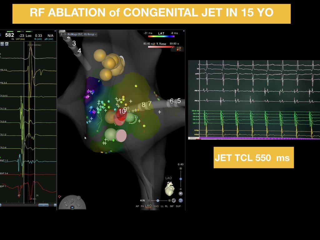 Congenital junctional ectopic tachycardia in 15 yo boy symptomatic and in wo from Betablock, EP study without anesthesia, negative genetic test. #carto. RF Cardiac ablation (close to CS) . Done ! #epeeps #arrhythmias #pediatriccardiology
Ospedale San Vincenzo