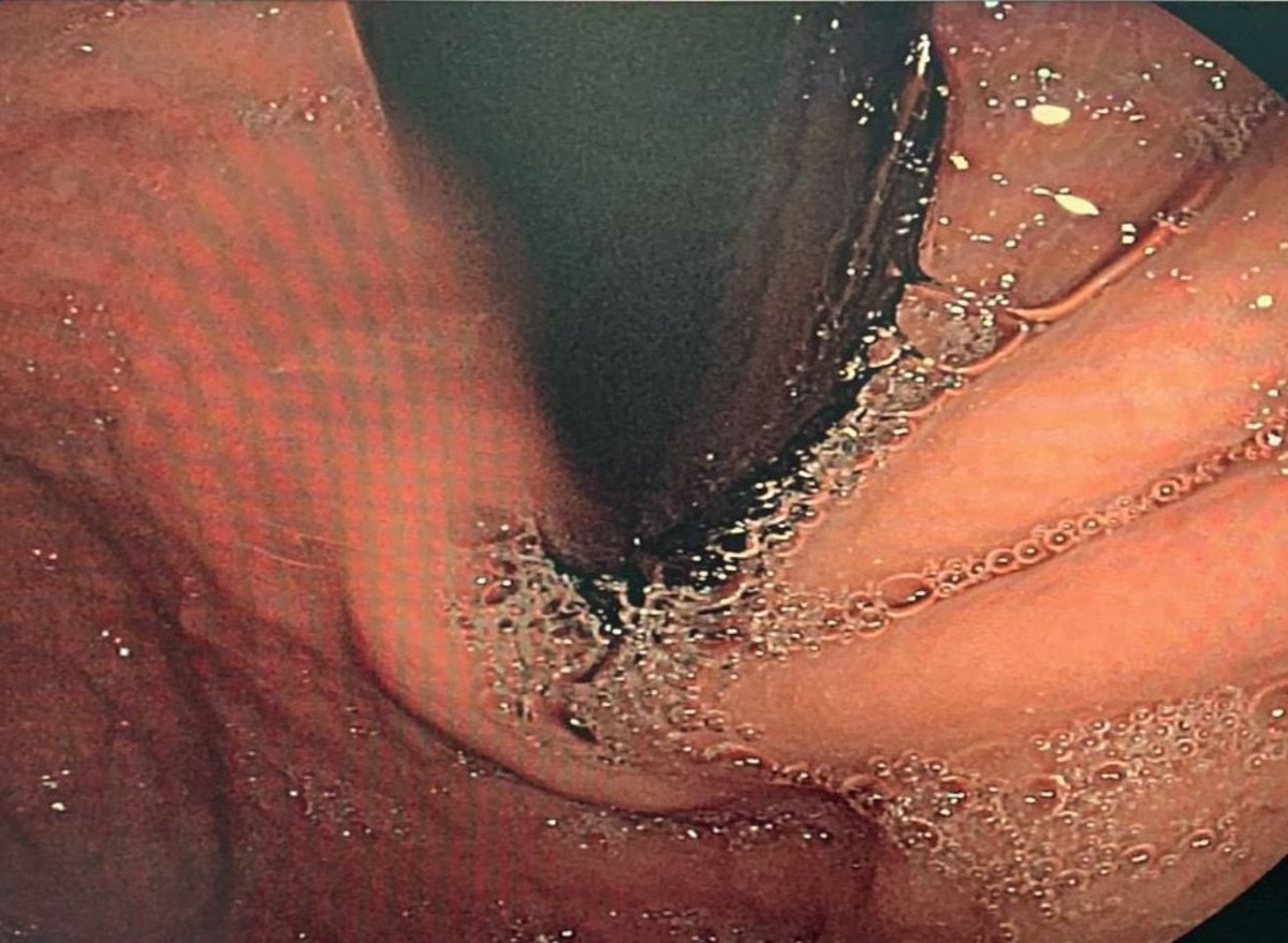 drkeithsiau's tweet photo. Endoscopic findings in the stomach of a 65M from Saudi Arabia with diabetes and severe anaemia. What’s the diagnosis? #TwitterConsult https://t.co/9HLMxRAT8K