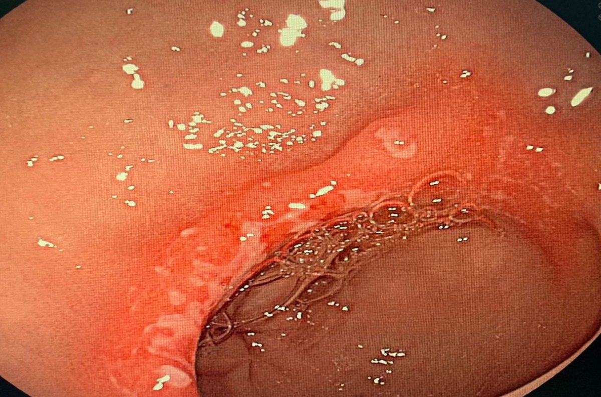 drkeithsiau's tweet photo. Endoscopic findings in the stomach of a 65M from Saudi Arabia with diabetes and severe anaemia. What’s the diagnosis? #TwitterConsult https://t.co/9HLMxRAT8K