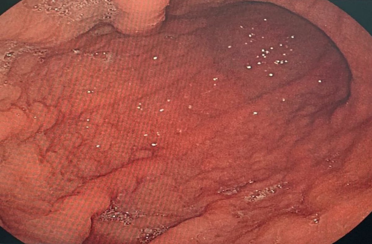 drkeithsiau's tweet photo. Endoscopic findings in the stomach of a 65M from Saudi Arabia with diabetes and severe anaemia. What’s the diagnosis? #TwitterConsult https://t.co/9HLMxRAT8K