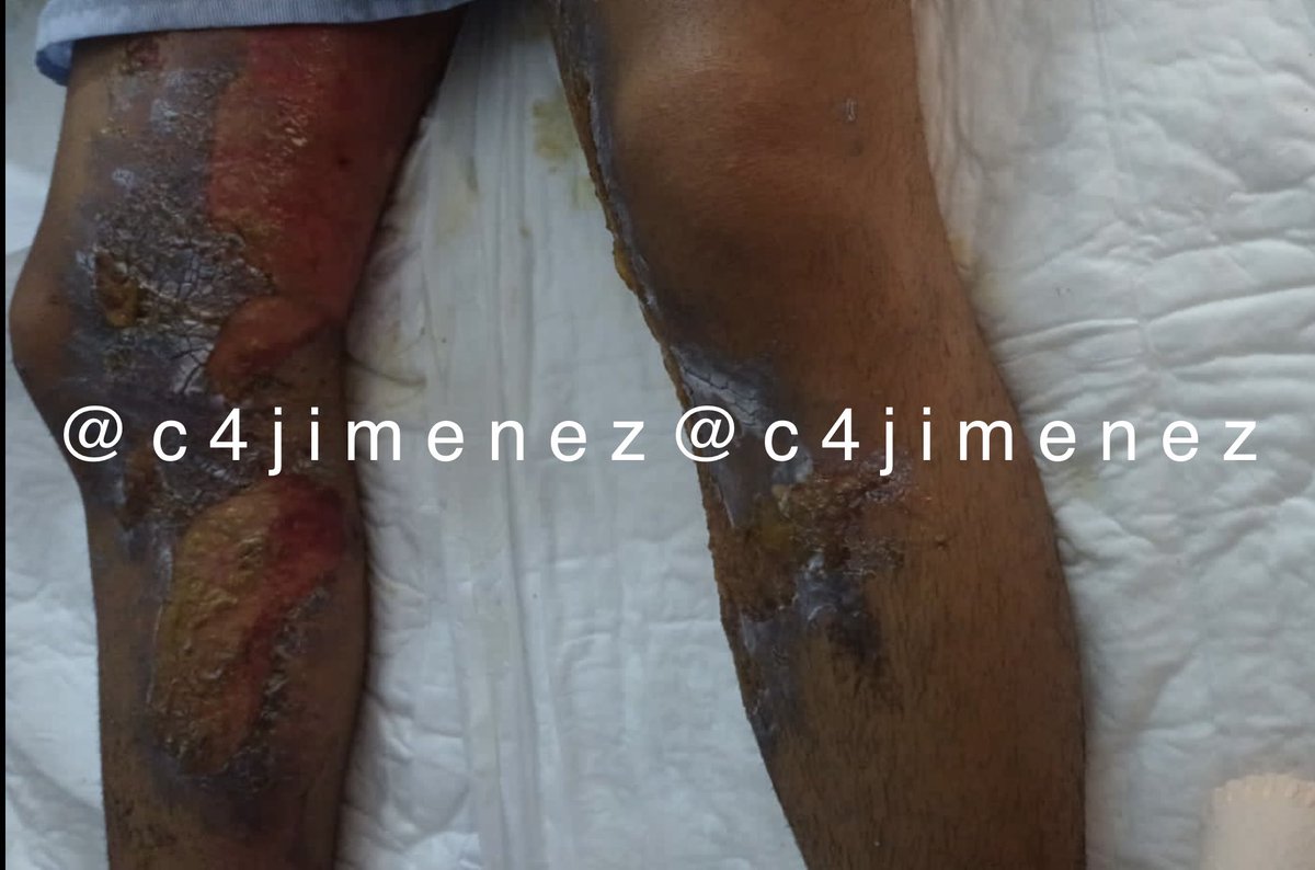 c4jimenez's tweet photo. LE PRENDEN FUEGO a SU COMPAÑERO en la PREPA!
Así quedaron las piernas de Cristhian.
Alumnos del @CEDVAOFICIAL de Texcoco le prendieron fuego en el colegio.
En la escuela nadie se hace responsable.
La @SEP_mx tampoco.
La @FiscaliaEdomex investiga. 

El caso en #C4EnAlerta https://t.co/qgRJ4VnOgx