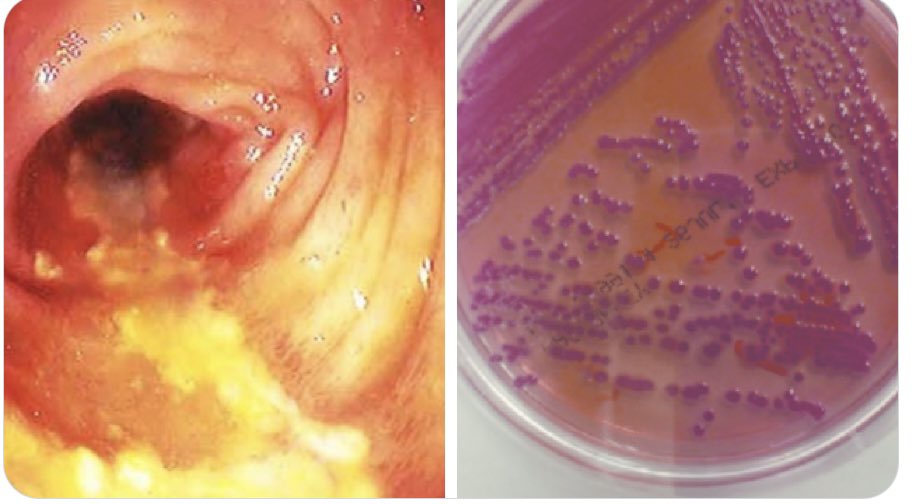 IUIDfellowship's tweet photo. #idboardreview Pt recently took amoxicillin for sinusitis &amp; now w/ fever, abd pain, bloody diarrhea. Colonoscopy hemorrhagic colitis without pseudomembranes. Cdiff neg. Stool GNR. dx? #meded #idmeded #IDtwitter https://t.co/bBRQFpKQq1