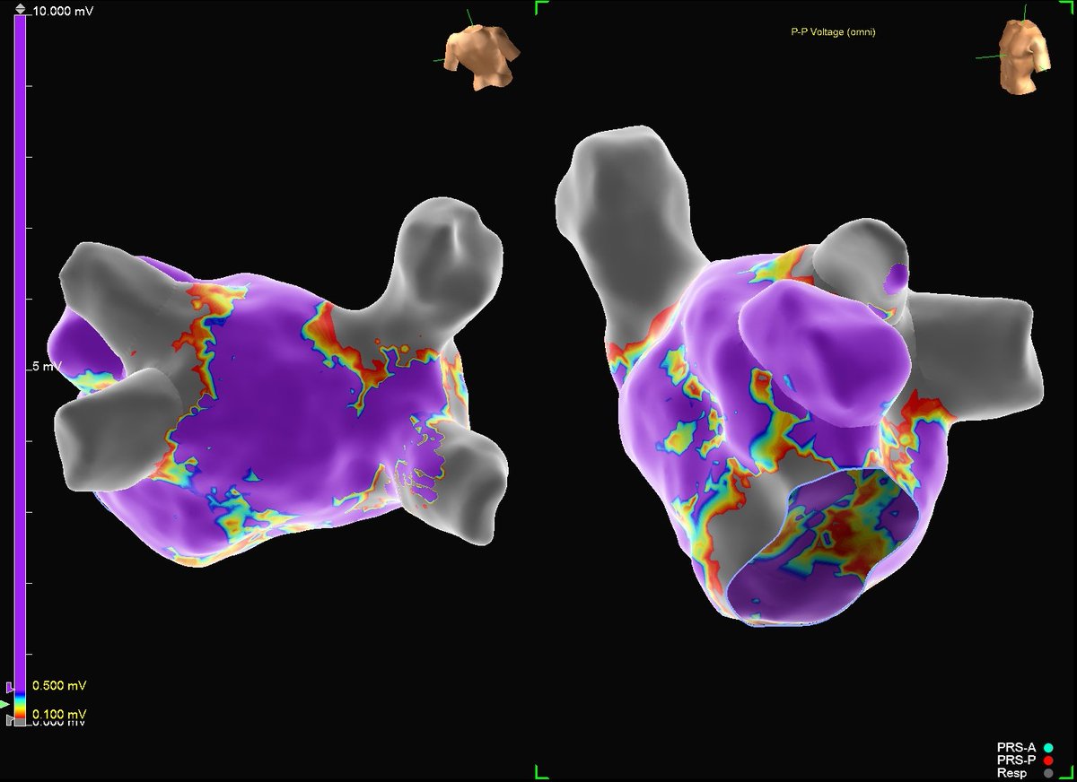 Hapa_EP's tweet image. There was a prior lateral mitral isthmus line performed though, although it does not appear blocked. Would adding both anterior and roof lines in this case possibly create greatly delayed conduction to the LAA?