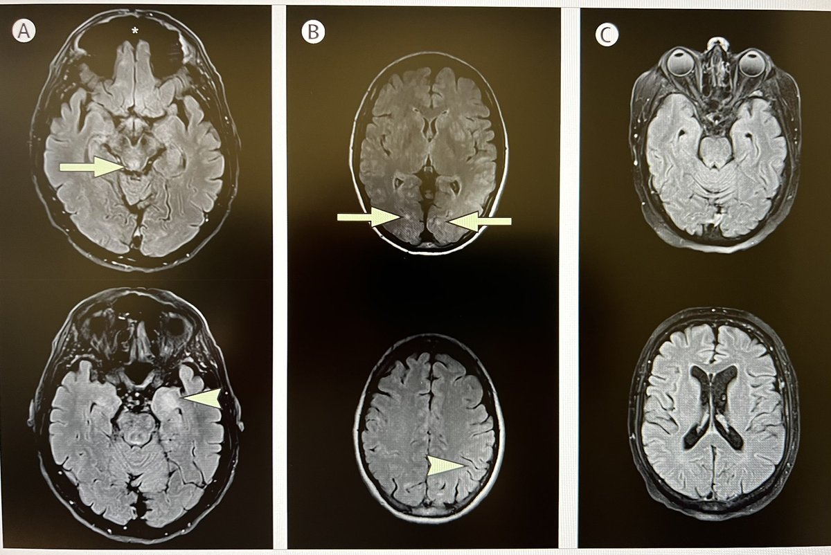 Neurological adverse events related to immune-checkpoint inhibitors in Spain: a retrospective cohort study

thelancet.com/journals/laneu…