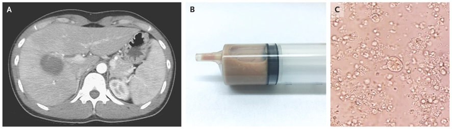 29 años👨, Taiwán, VIH+: fiebre y dolor hipocondrio dcho.

AST 208 UI/L, ALT 467 UI/L, TBIL 2,4 mg/dL, CD4  520/μL

(A) TC: sugestivo de absceso hepático
(B) Drenaje percutáneo y (C) examen microscópico
1/3

DOI: 10.1056/NEJMicm1800360
#microbiología #infecciosas