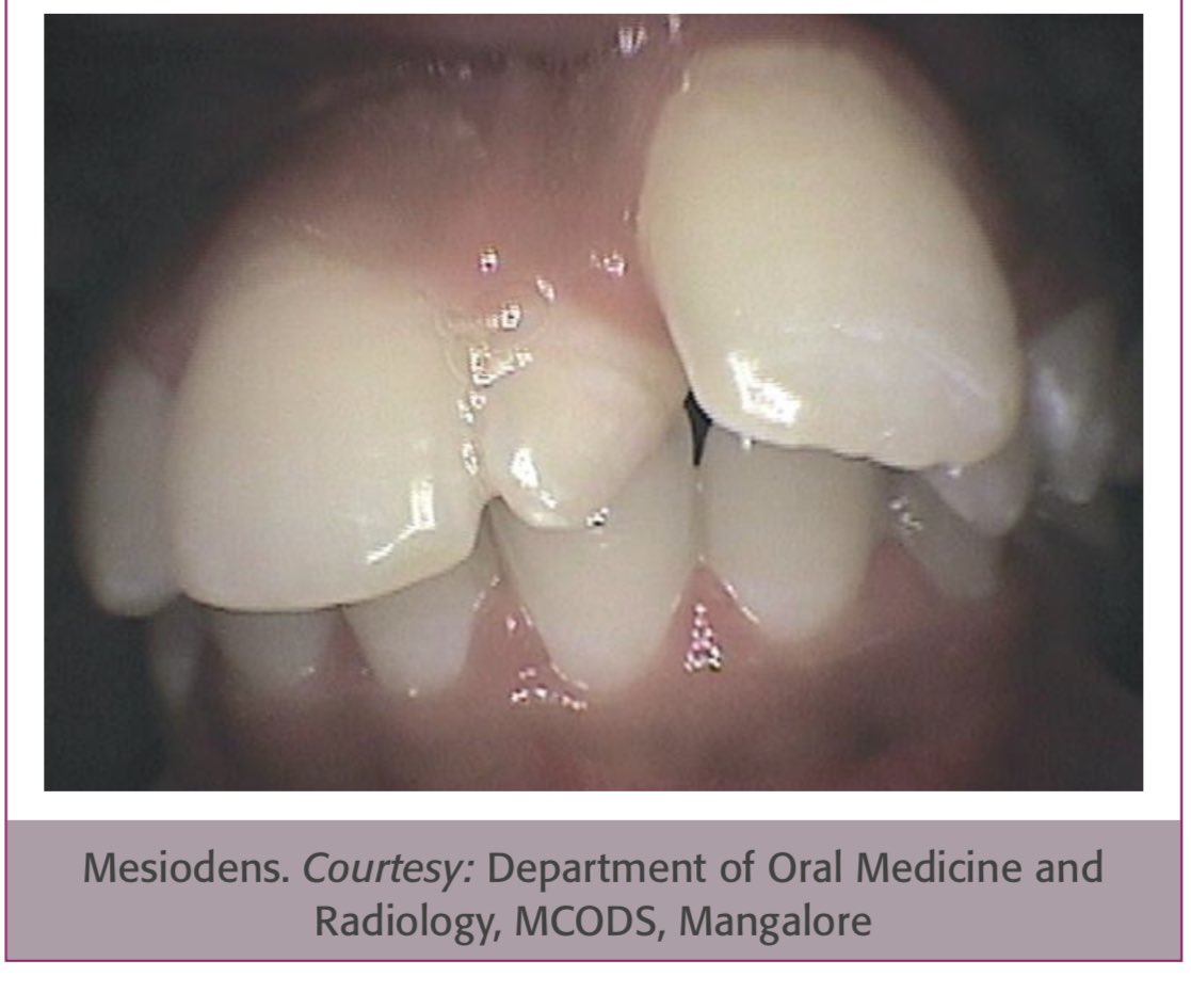Familial multiple impacted supernumerary teeth: Case report - Loulwah K  Alothman, Azizah F Bin Mubayrik, Reema Alshawaf, Randa Alfotawi, Abdulaziz  S Alqahtani, 2025, image size:1117x945