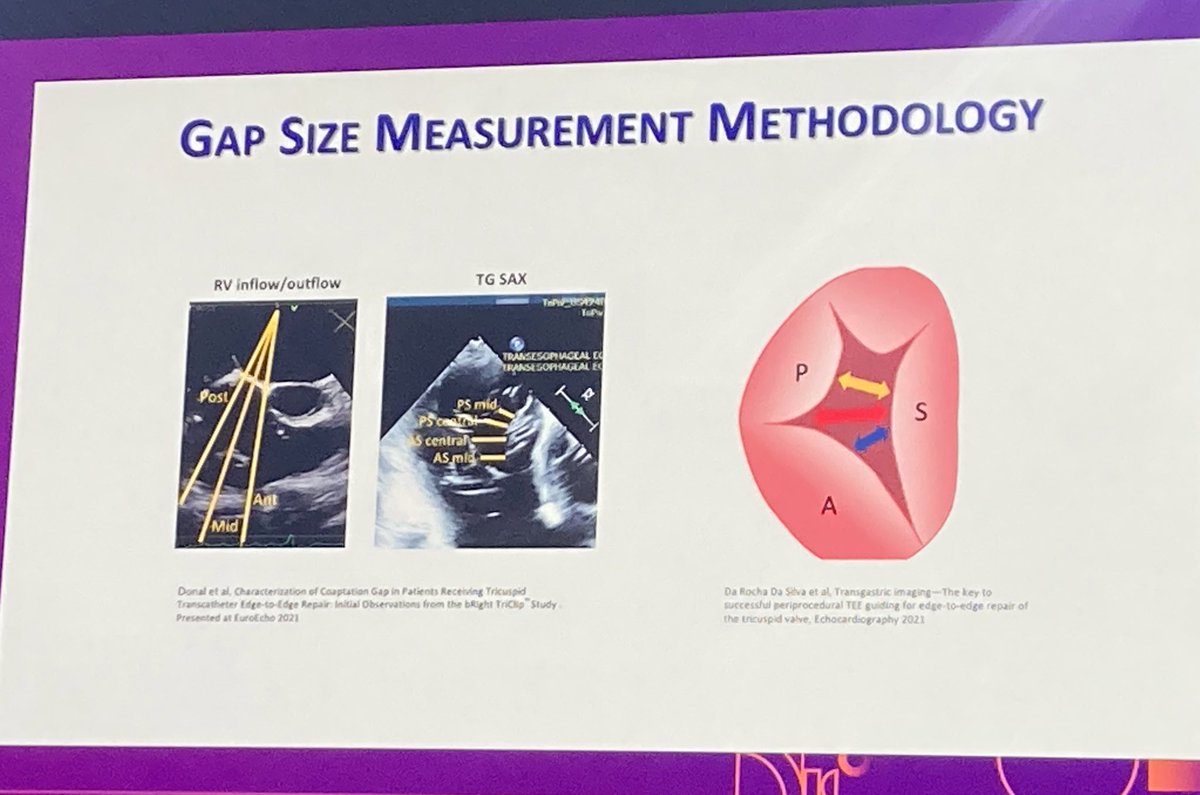 Sticchi_Alex's tweet image. Where do you measure #GAP size??
#Tricuspid #TEER #PCRLV 

#PCRTricuspid
@PCRonline @drmaisano @hahn_rt @dralisonduncan @JGrapsa
@kiadeb87 @Dr_Harriet @Sticchi_Alex @dromar_c @VDelgadoGarcia @cvnurselin @DrArifK @PamelaGatto @ABeneduceMD @CurioJonathan @jcecharte @EZancanaroMD