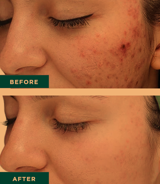 SmoothSynergy's tweet image. We ❤️ the VI Peel. Learn why this chemical peel is so great for acne, acne scars and hyperpigmentation, including dark marks and age spots: smoothsynergy.com/vi-peel-purify