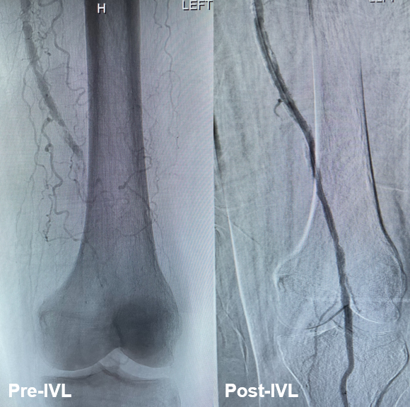 ShockwaveIVL's tweet photo. Shock on! Dr Wadi Gomero-Cure at @SMHCS was faced w/ a totally occluded distal left SFA/popliteal. After navigating the ca++ lesion, he chose a 6.0mm #ShockwaveM5plus as the tool for the job & finished w/ a 5.0 DCB, leaving nothing behind.
US Rx only. ISI https://t.co/sZ0NdzXNcV https://t.co/5LAVKqDzUD