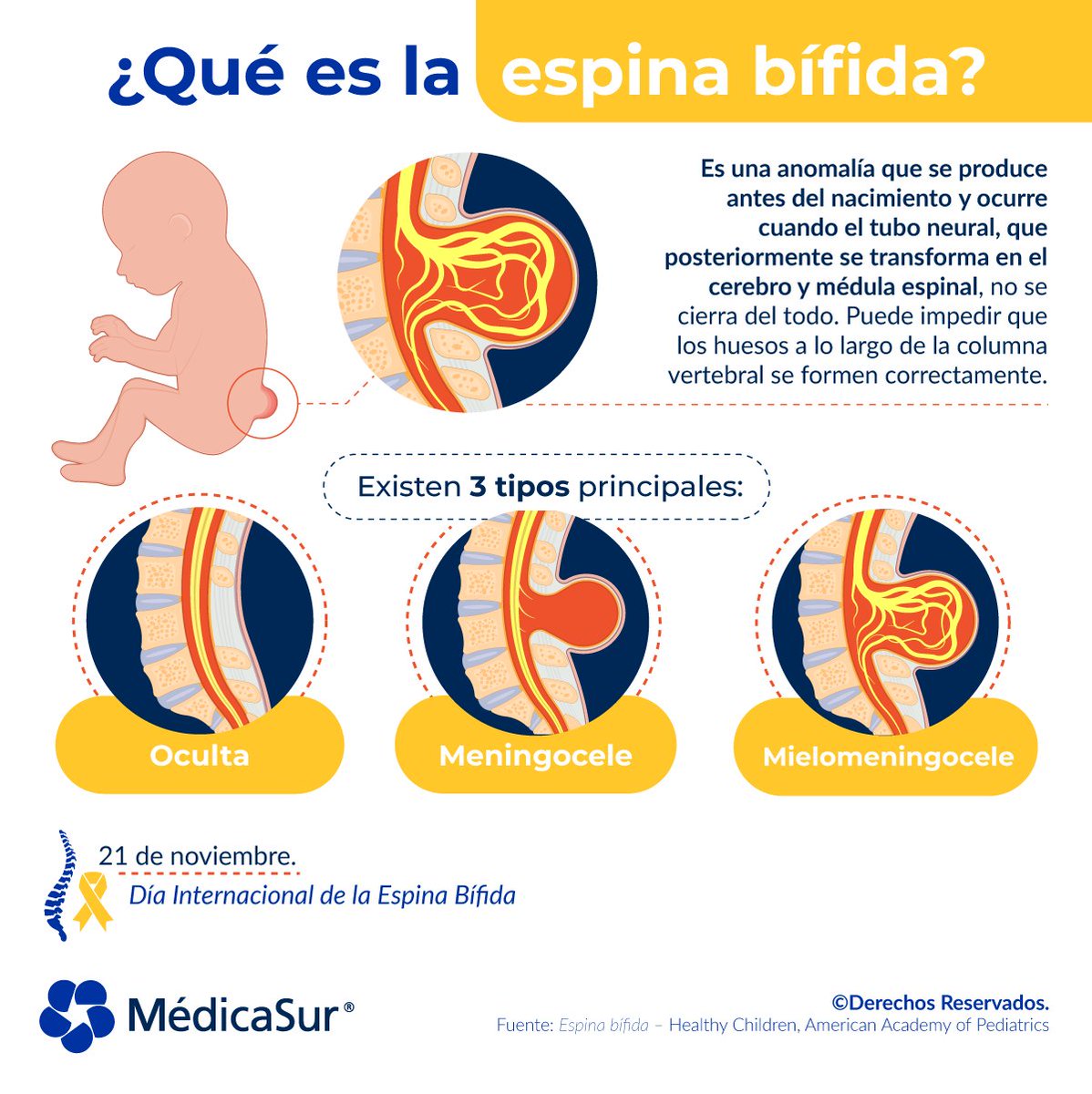 medicasur's tweet image. ¿Sabías que la #EspinaBífida es uno de los defectos #congénitos más comunes en los #bebés? Afecta su columna vertebral y médula espinal. ¡Conoce más al respecto aquí!

Conoce a nuestros especialistas en #pediatría: 
bit.ly/pedia23t

#DíaMundialDeLaEspinaBífida