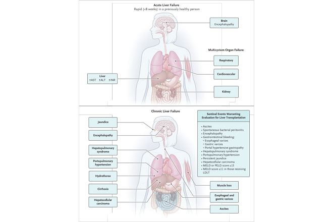 Clinical Pearls & Morning Reports: Liver Transplantation. What strategies are currently used to expand the pool of available livers for transplantation? resident360.nejm.org/content-items/… #MedEd #MedTwitter #livertransplant