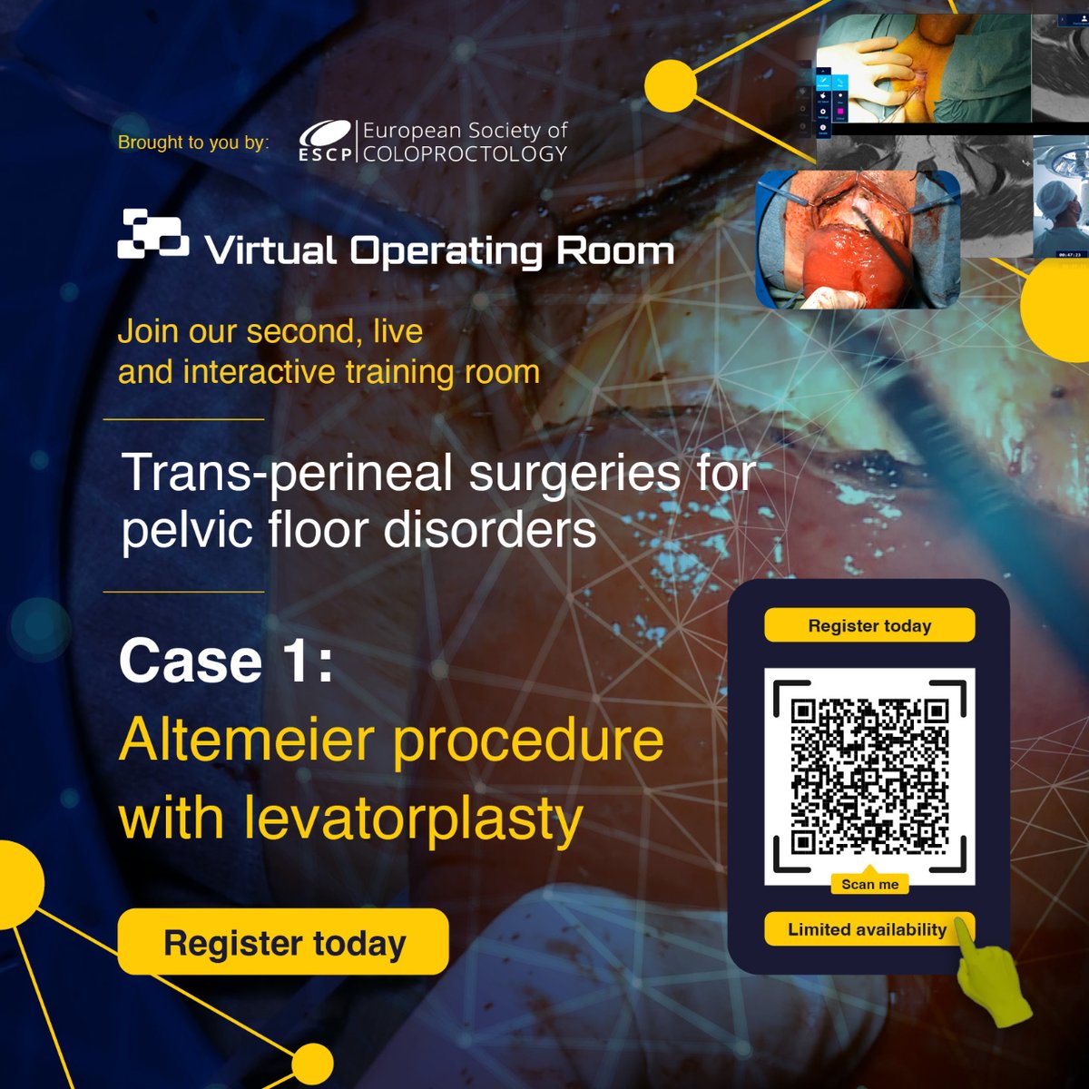 European Society of Coloproctology (@escp_tweets) on Twitter photo Join us for our 2nd Virtual Operating Room event on Trans-Perineal Surgeries!
Witness live cases, including the Altemeier Procedure with Levatorplasty.
Register: mtr.cool/aetkjahzpo
#PelvicFloorSurgery #VirtualOR
<a href="/PFCNaldini/">Gabriele Naldini</a> <a href="/Dr_A_Sturiale/">Alessandro Sturiale</a> <a href="/ColorectalDis/">Colorectal Disease</a> <a href="/mia_imran_aslam/">Imran Aslam</a> Join us for our 2nd Virtual Operating Room event on Trans-Perineal Surgeries!
Witness live cases, including the Altemeier Procedure with Levatorplasty.
Register: mtr.cool/aetkjahzpo
#PelvicFloorSurgery #VirtualOR
<a href="/PFCNaldini/">Gabriele Naldini</a> <a href="/Dr_A_Sturiale/">Alessandro Sturiale</a> <a href="/ColorectalDis/">Colorectal Disease</a> <a href="/mia_imran_aslam/">Imran Aslam</a>