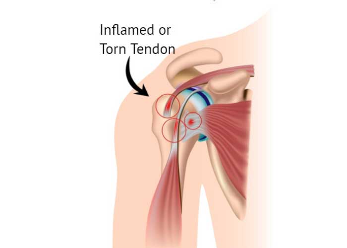 The goal of a #biceps #tenodesis procedure is to reduce the irritation in the tendon by stabilizing its insertion site. Reattaching the tendon using the tenodesis procedure reduces pain and restores arm and shoulder function. medilink.us/lya4 #orthotwitter