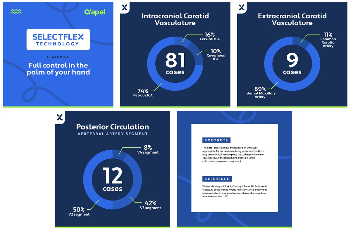 q_apel's tweet image. Q'Apel Medical’s patented #SelectFlex™ Technology places full control in the palm of your hand, allowing physicians to seamlessly adapt the catheter to strike the ideal balance between #trackability and #support, on demand. 
#FullControl #RadialAccess #QapelMedical #Armadillo