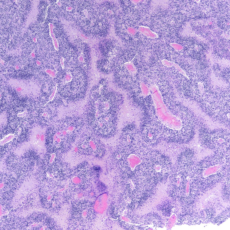 Sometimes palisading necrosis is so confluent in a #glioblastoma, it looks like a jigsaw puzzle. #pathology #neuropath #pathtwitter
