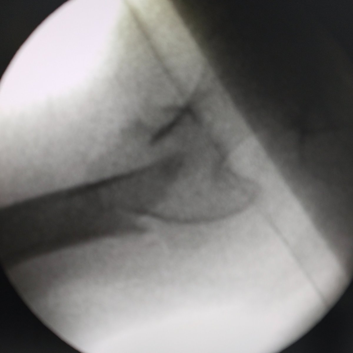 pratikorho's tweet photo. Unstable Reverse Oblique Intertrochanteric Fracture

Proximal fragment is in...
Abduction - image 1
&amp; Flexion + ER - image 2 &amp; 3

Reduction achieved with spike pushing down to correct flexion + ER

&amp;

Lateral compression by hand for abduction 

#medtwitter #orthotwitter https://t.co/pgBXUor2ZT