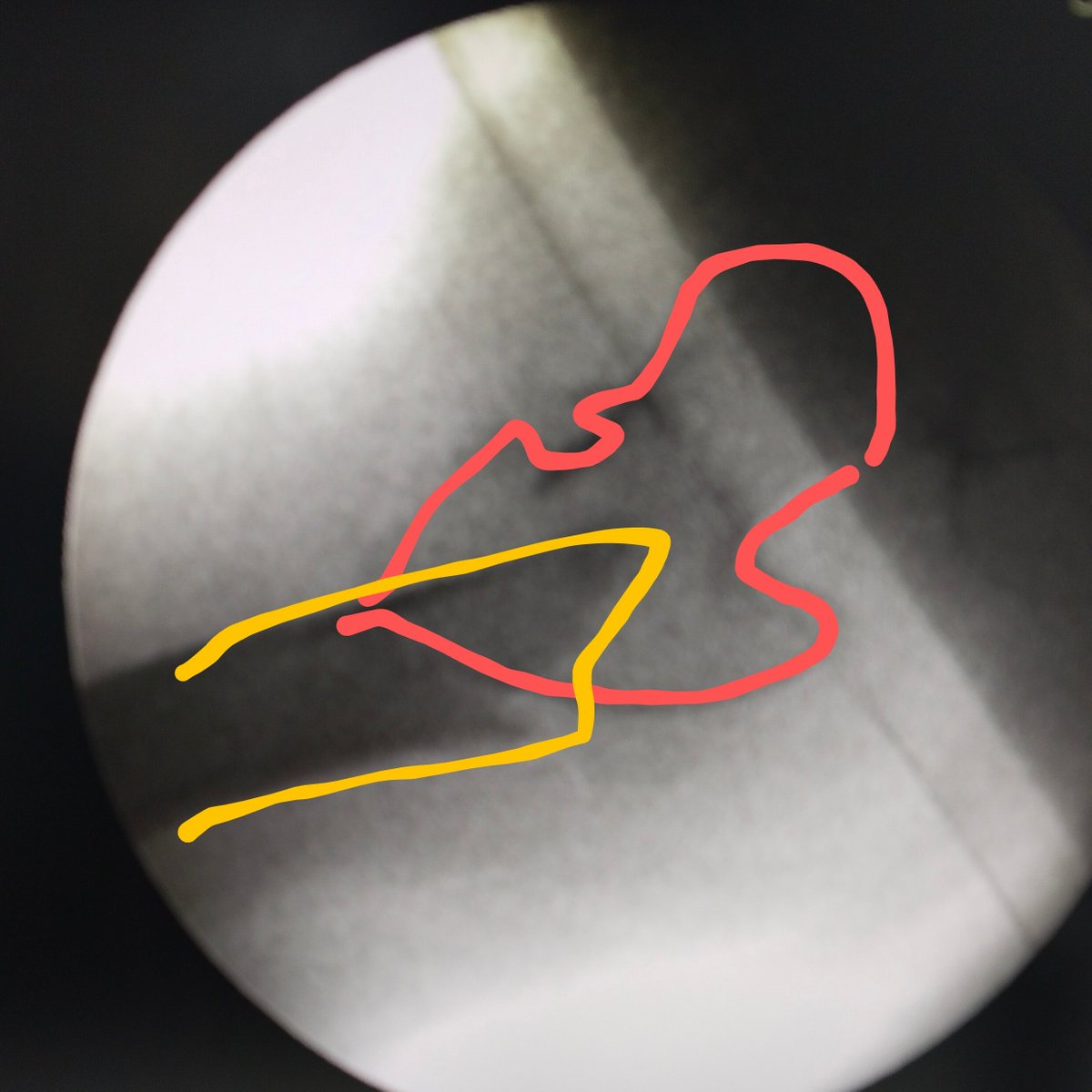 pratikorho's tweet photo. Unstable Reverse Oblique Intertrochanteric Fracture

Proximal fragment is in...
Abduction - image 1
&amp; Flexion + ER - image 2 &amp; 3

Reduction achieved with spike pushing down to correct flexion + ER

&amp;

Lateral compression by hand for abduction 

#medtwitter #orthotwitter https://t.co/pgBXUor2ZT