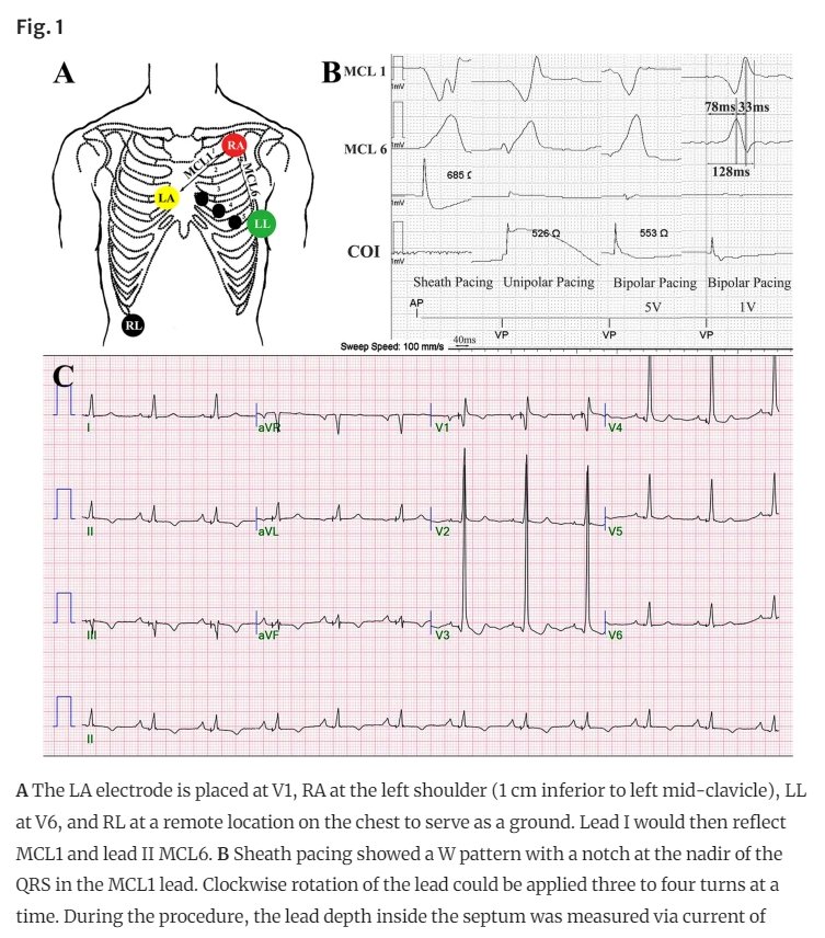 ZHeart11768530's tweet image. 🚨 Left Bundle Branch Area Pacing without an Electrophysiologic Recording System Using Modified Chest Lead @JICE_EP
 #FreeRead 
🧐📖rdcu.be/drzUD

#EPeeps #cardioTwitter #CardioEd #Cardiology