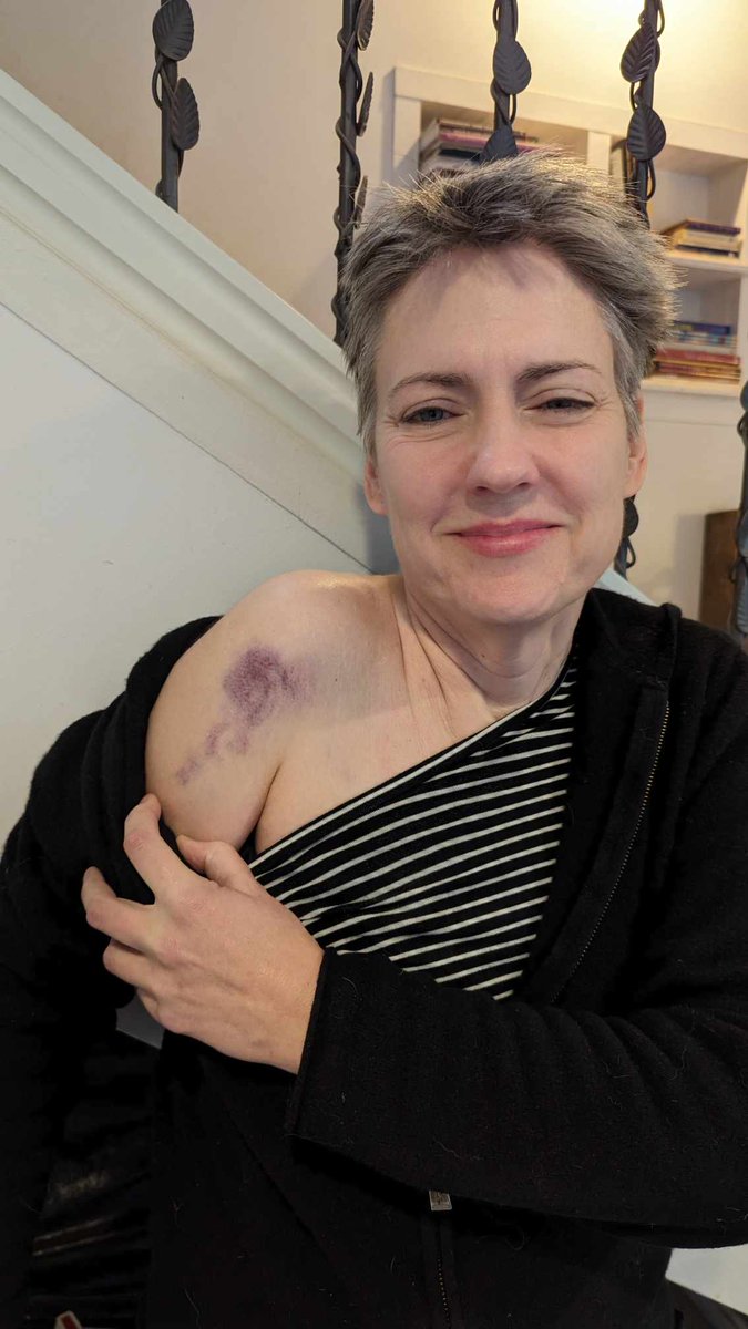 heterodoxan's tweet photo. Lierre Keith never wore makeup in all the years I worked with her. Not for going to DC to meet with important political figures, on any Zooms, not for DC rallies where we might have expected press.

Then she went somewhere dangerous.

Winning smile. Lipstick. Eyeliner. Bruise. https://t.co/TFwz0iIo7q
