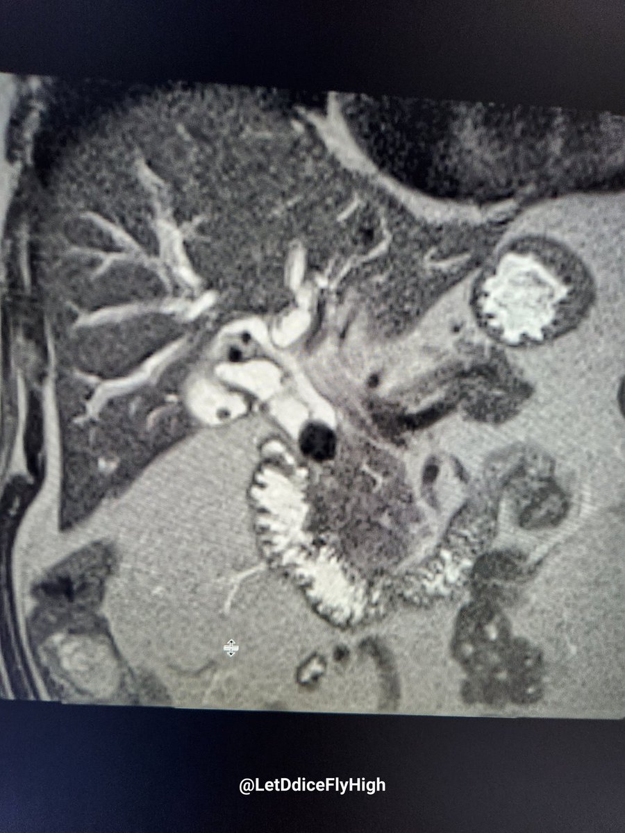 LetDdiceFlyHigh's tweet photo. Which syndrome was proved by the ERCP done after the MRCP? https://t.co/TWOYotAVou