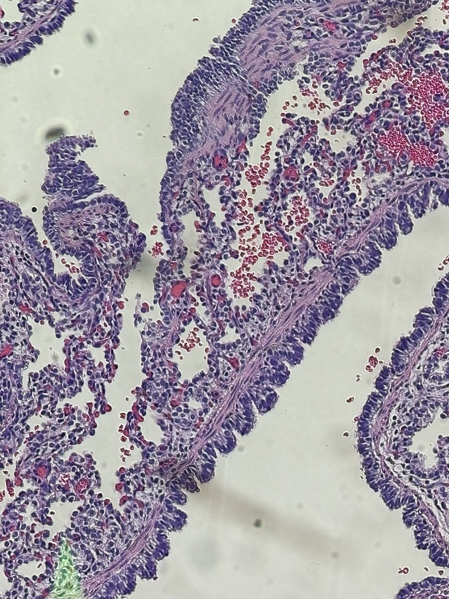 ahsanuitis's tweet photo. 🔹Congenital pulmonary airway Malformation (CPAM)
💡a.k.a cystic adenomatoid malformation 
💡Hamatomatous
💡Multiple irregular cystic spaces lined by respiratory epithelium with interspersed alveolar spaces.

#pedipath #TwitterHomework https://t.co/BcLR6XJNy3