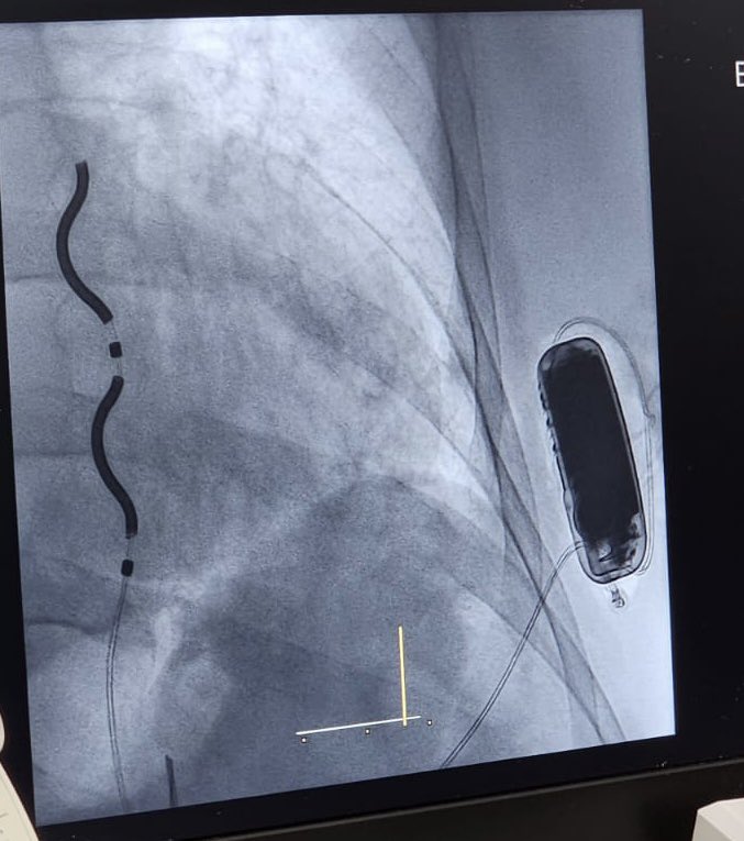 Paolo D. Dallaglio (@pau79_ep) on Twitter photo First successful extravascular ICD implant today at <a href="/hbellvitge/">Hospital Universitari Bellvitge | HUB</a>. Thanks to our great EP team, thanks to all <a href="/MDT_Cardiac/">Medtronic Cardiac</a> staff for supporting this new revolutionary technology, thanks to Dr. Jaime Casares for his teaching and advices! Será la Aurora! First successful extravascular ICD implant today at <a href="/hbellvitge/">Hospital Universitari Bellvitge | HUB</a>. Thanks to our great EP team, thanks to all <a href="/MDT_Cardiac/">Medtronic Cardiac</a> staff for supporting this new revolutionary technology, thanks to Dr. Jaime Casares for his teaching and advices! Será la Aurora!