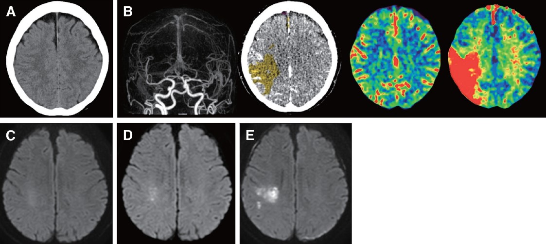Advance Online Publication
Predictive Value of Acute Neurological Progression Using Bayesian CT Perfusion for Acute Ischemic Stroke with Large or Median Vessel Occlusion
doi.org/10.5797/jnet.o…