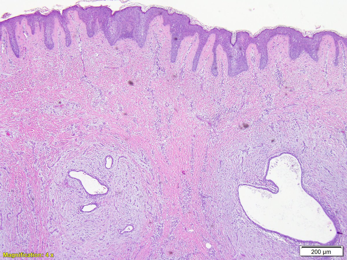 LoyolaDermPath's tweet photo. A 45-year-old female with intermittent sharp pain at the umbilicus. On examination, there was an umbilical nodule. An excisional skin biopsy was performed. What is your diagnosis? @JJSpeiserMD https://t.co/OP0i6Ylqav