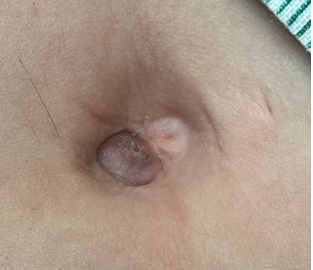 LoyolaDermPath's tweet photo. A 45-year-old female with intermittent sharp pain at the umbilicus. On examination, there was an umbilical nodule. An excisional skin biopsy was performed. What is your diagnosis? @JJSpeiserMD https://t.co/OP0i6Ylqav