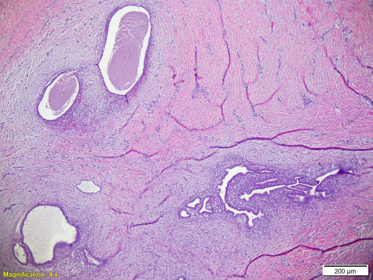 LoyolaDermPath's tweet photo. A 45-year-old female with intermittent sharp pain at the umbilicus. On examination, there was an umbilical nodule. An excisional skin biopsy was performed. What is your diagnosis? @JJSpeiserMD https://t.co/OP0i6Ylqav