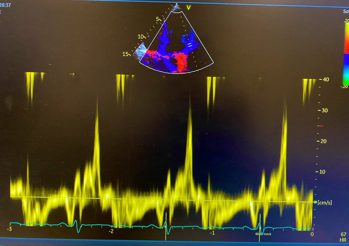 lukasz_zydzik's tweet photo. Beautiful case of arrhytmogenic MVP in a 26 yo woman
#echofirst #cardioTwitter https://t.co/OfxUBYE2HZ