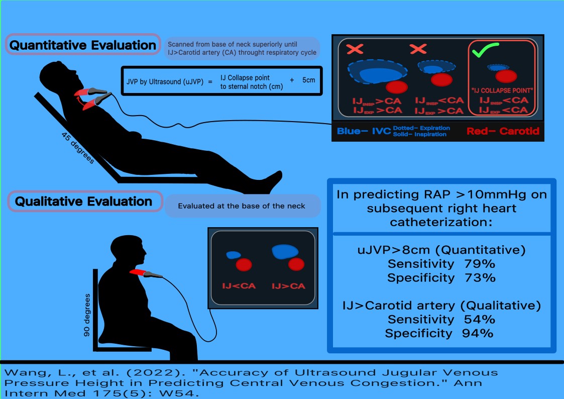 BodkerKevin's tweet photo. POCUS exam of the IJ is simple and may provide useful information, particularly for those with with limited experience or for patients with challenging body habitus. I loved this study and wanted to try my hand at infographic (feedback welcome). #Medtwitter #nephtwitter #POCUS https://t.co/9l4ldsUqf2