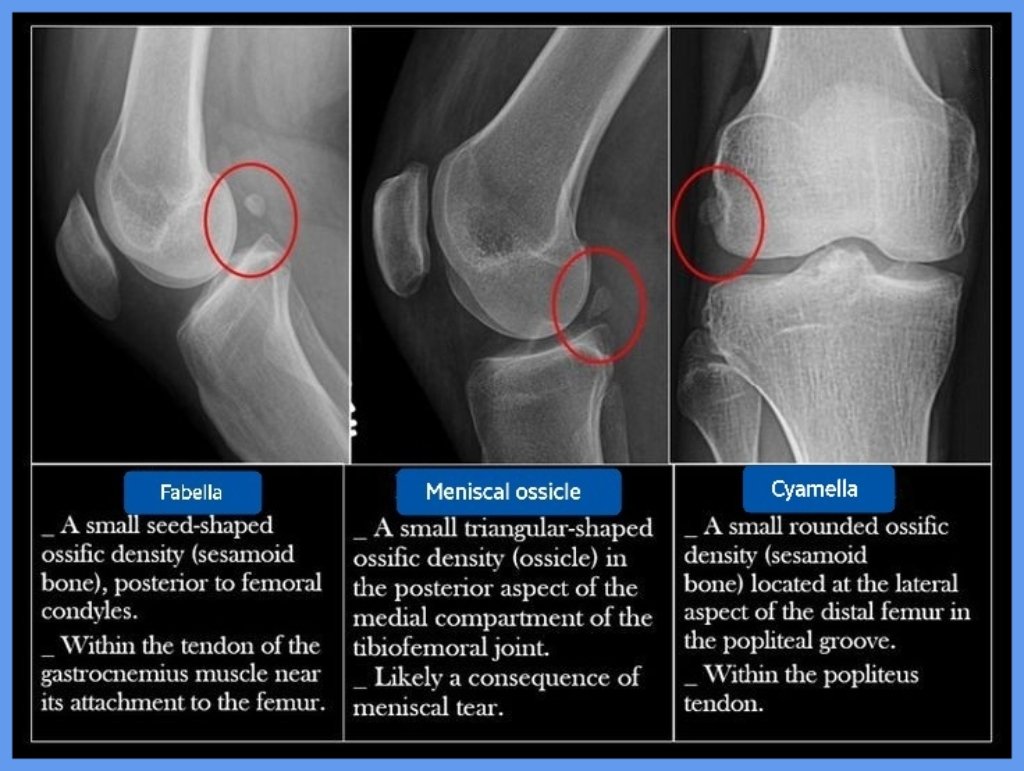 Fabella vs Meniscal ossicle vs Cyamella It's important to know these entities in order not to be confused with pathologic lesions. For example Meniscal ossicle, commonly confused with a loose body both clinically & radiologically.pin.it/5K2yvKE