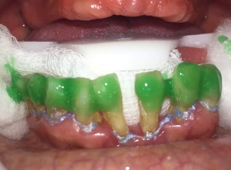 CDBethsaira's tweet photo. Dr. solo quiero un blanqueamiento dental y donde queda la Enfermedad Periodontal?? 
( no es mi caso peeerooo del dentista de la esquina siii ) jajaja. https://t.co/pZcHpxK7sf