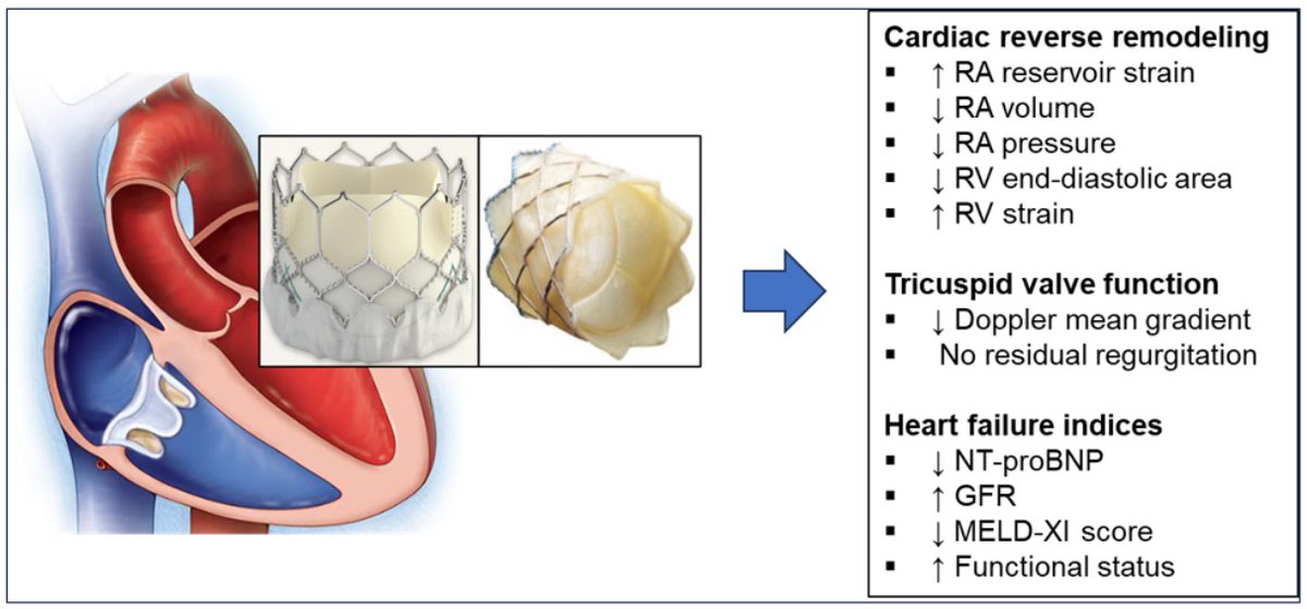 CircInterventions (@circintv) on Twitter photo Transcatheter Tricuspid Valve-in-Valve Replacement in Adults with Congenital Heart Disease: A viable alternative to surgical TVR <a href="/Dr_JHAnderson/">Jason H. Anderson, M.D.</a> <a href="/CharlieJainMD/">Charlie Jain</a> <a href="/CircHF/">Circ: Heart Failure</a> <a href="/AHAScience/">AHA Science</a> #Cardiotwitter #AHAJournals
ahajrnls.org/3SPC3NW Transcatheter Tricuspid Valve-in-Valve Replacement in Adults with Congenital Heart Disease: A viable alternative to surgical TVR <a href="/Dr_JHAnderson/">Jason H. Anderson, M.D.</a> <a href="/CharlieJainMD/">Charlie Jain</a> <a href="/CircHF/">Circ: Heart Failure</a> <a href="/AHAScience/">AHA Science</a> #Cardiotwitter #AHAJournals
ahajrnls.org/3SPC3NW