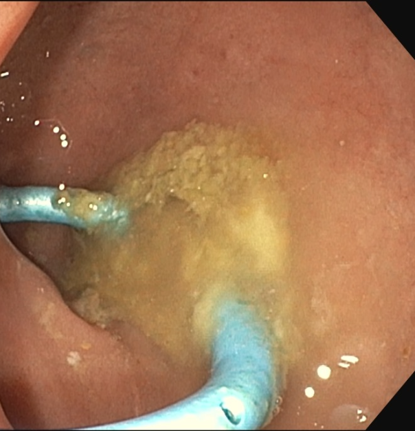 Erik Holzwanger, MD, ABOM-D (@hilarholzy) on Twitter photo Endoscopic internal drainage is 🚀
66 y/o F hx of duodenal ulcer perf 1 year ago s/p graham patch now worsening abd pain and CT ▶️ 6cm fluid collection
What are your thoughts on EID and next steps here? <a href="/ChahalPrabhleen/">Prabhleen Chahal MD,MASGE,FACG</a> <a href="/TrieuMD/">Judy Trieu, MD, MPH</a> <a href="/AlexanderPodboy/">Alexander Podboy, MD, DABOM</a> <a href="/docdhir/">vinay dhir</a> #GITwitter #MedEd Endoscopic internal drainage is 🚀
66 y/o F hx of duodenal ulcer perf 1 year ago s/p graham patch now worsening abd pain and CT ▶️ 6cm fluid collection
What are your thoughts on EID and next steps here? <a href="/ChahalPrabhleen/">Prabhleen Chahal MD,MASGE,FACG</a> <a href="/TrieuMD/">Judy Trieu, MD, MPH</a> <a href="/AlexanderPodboy/">Alexander Podboy, MD, DABOM</a> <a href="/docdhir/">vinay dhir</a> #GITwitter #MedEd
