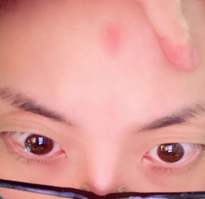 おはようございます。 起きたら何かおでこの真ん中にめっちゃ真っ赤な痣があるんだが??? 覚えが全く無いんだが? 寝てる間にめっちゃ指でグーって押された…?? まじで印の様に真っ赤っかなんだが? 何?開眼?
