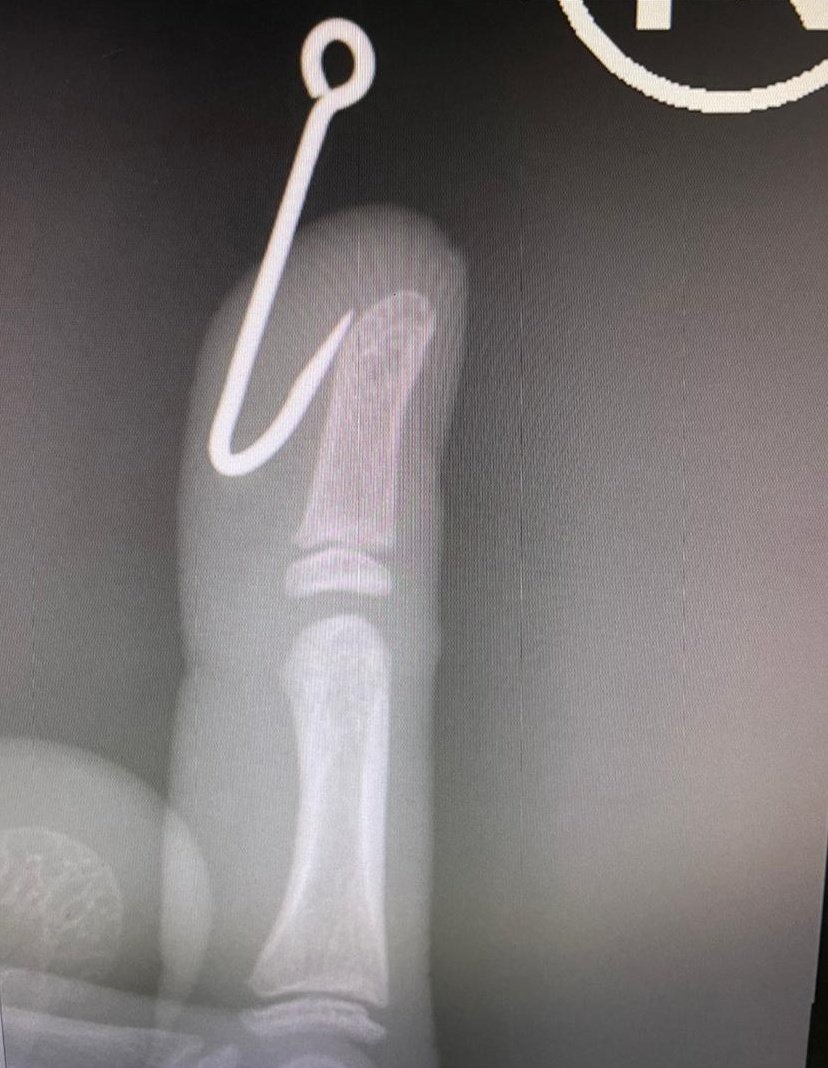 khaledvic13's tweet photo. Fish hook 🎣  removed in Pedia ER  #vacationCases https://t.co/6CL3pNXcrW