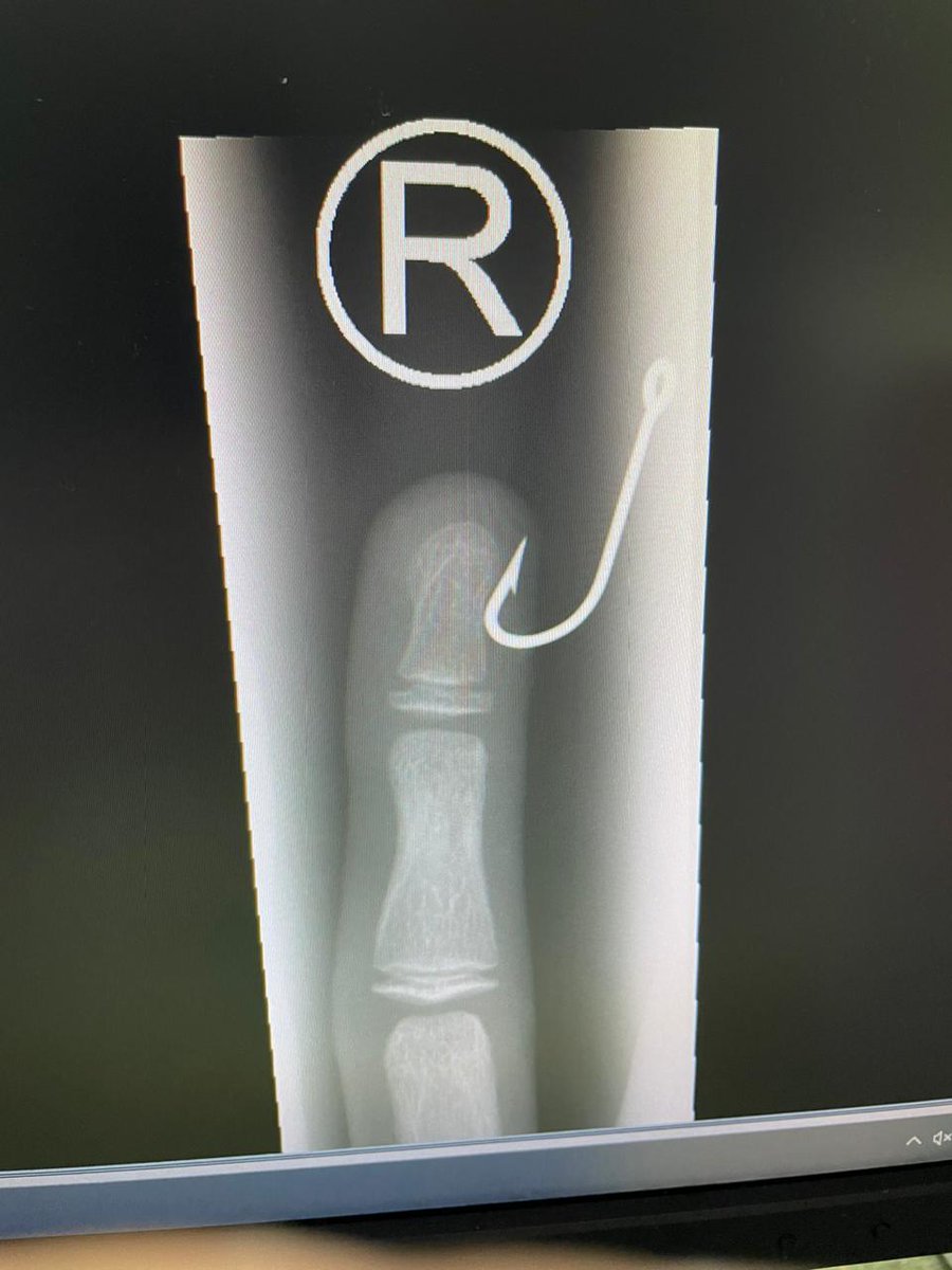 khaledvic13's tweet photo. Fish hook 🎣  removed in Pedia ER  #vacationCases https://t.co/6CL3pNXcrW