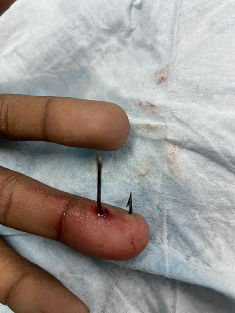khaledvic13's tweet photo. Fish hook 🎣  removed in Pedia ER  #vacationCases https://t.co/6CL3pNXcrW
