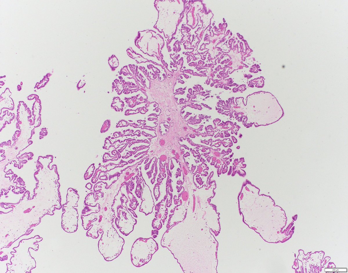 3rd ventricle brain mass, likely diagnosis? #PathTwitter #pedipath #neuropath