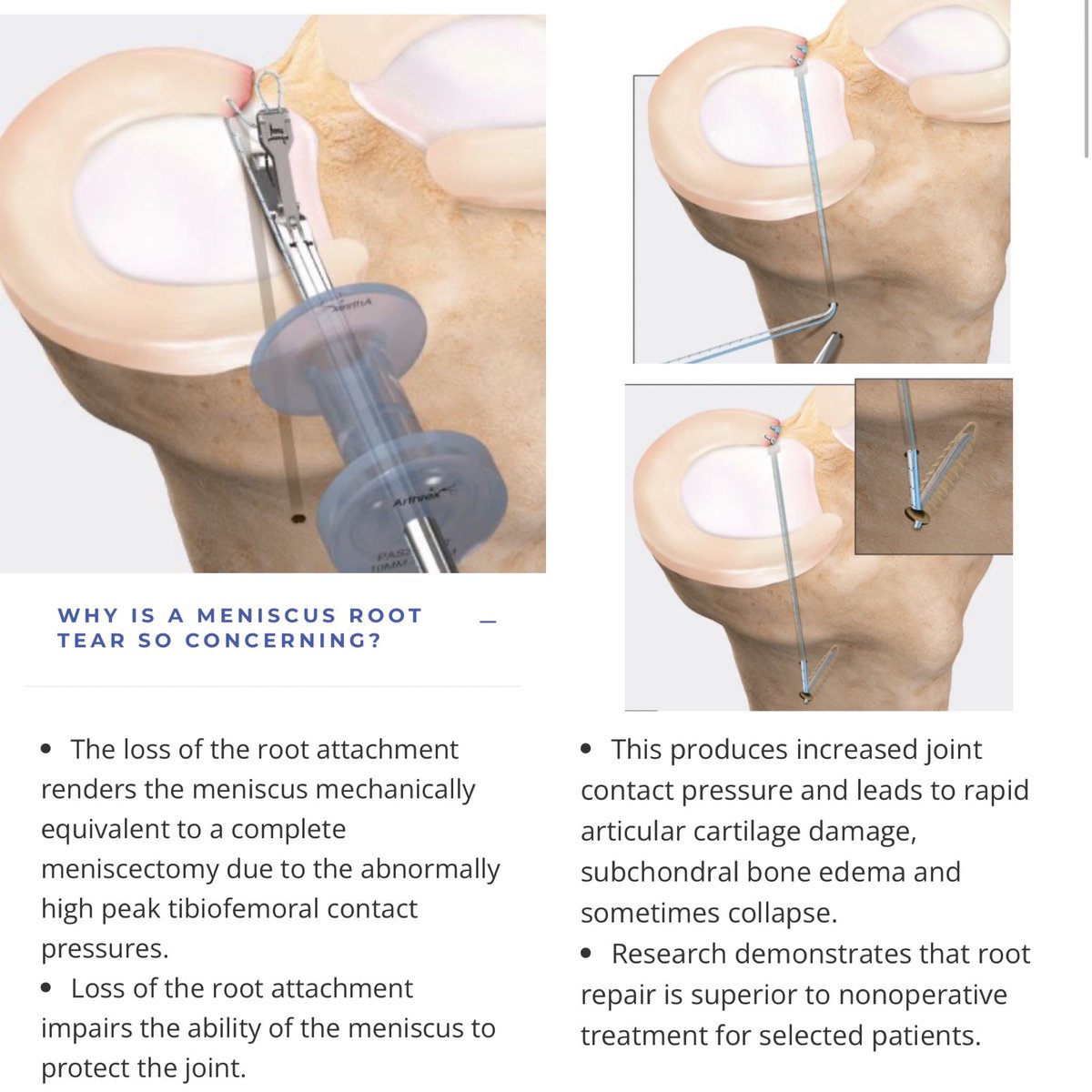 drchrisahmad's tweet photo. Focus On: Meniscal Root Repair 🔪

Why exactly is a meniscus root tear so concerning ❓

Learn More:
https://t.co/zUF0e8l6Qu ✅

Book Appoihtment:
https://t.co/9fFMUWYLMI 👨‍⚕️

#orthopedics #sportsmedicine #kneepain #kneeinjury
#kneesurgery #kneeexpert 🏆 https://t.co/R5FfhbUxqA