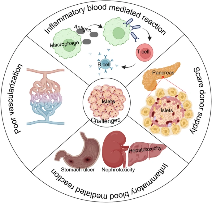 KoreaCRS's tweet photo. (Journal of Pharmaceutical Investigation) Advances in alginate encapsulation of pancreatic islets for immunoprotection in type 1 diabetes (https://t.co/JqxScBXtK6) | Jee-Heon Jeong | Sungkyunkwan University #JPIN #KPSPT https://t.co/9iODE5QnHf