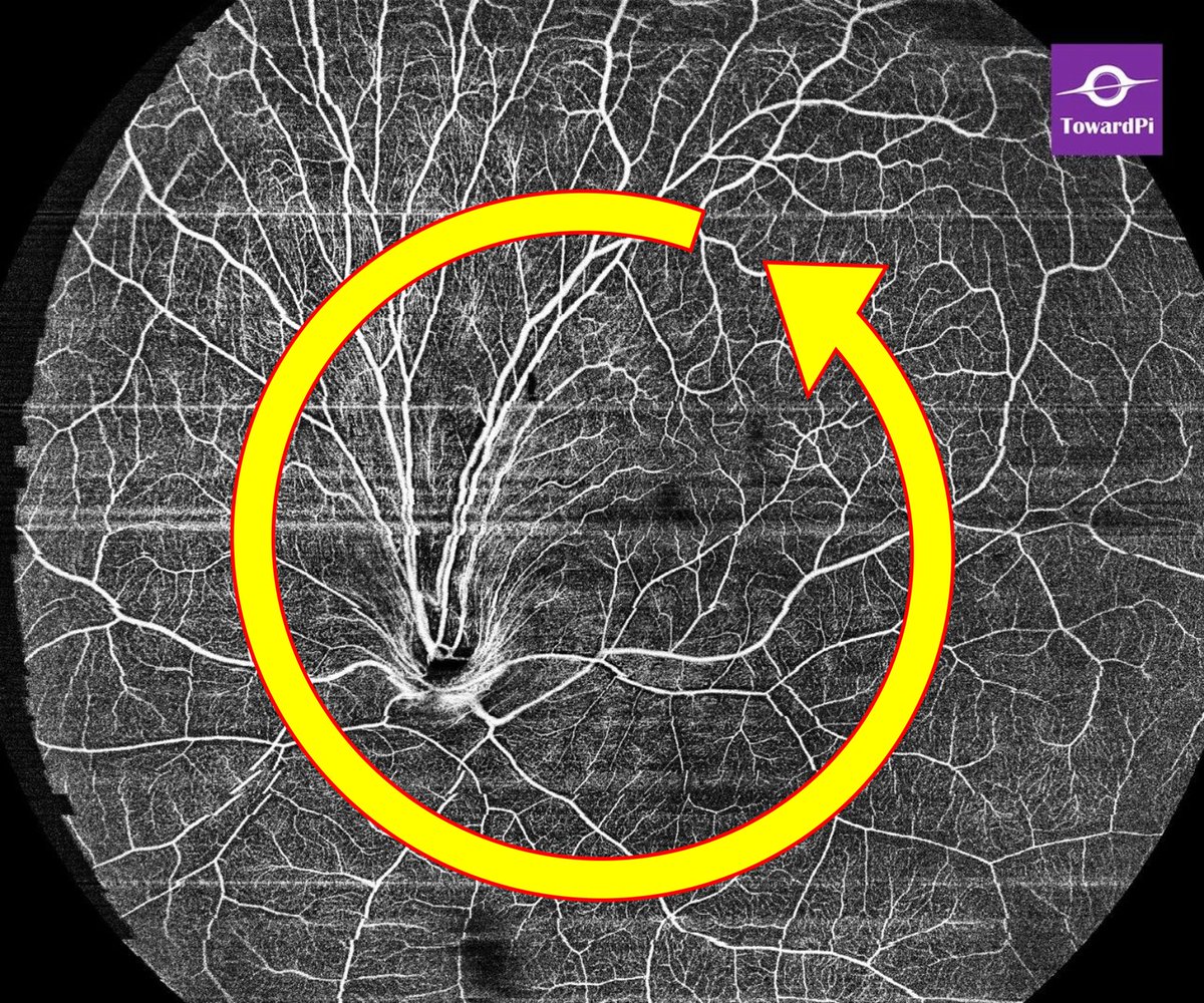 toward_pi's tweet photo. Congenital ectopic macula with optic disc rotation, #OCTA. Left eye monocularly, optic disc rotated counterclockwise, so were the distribution of nerve fiber layer and peripapillary capillaries. The macula shifted to the superior temporal of the disc. #Ophthalmology #SSOCT https://t.co/eNgEVl2LOD