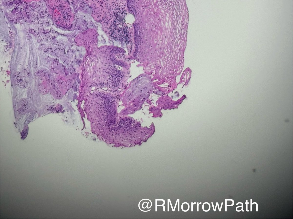 RMorrowPath's tweet photo. The perils of universal p16 ordering on cervical biopsies
😲some LSIL will be p16 positive 
🫣 there’s no correlation with biological behaviour
🫨 don’t call it HSIL unless you also have atypia extending into the mid third…. Be brave! 
#gynpath #pathology #pathtwitter https://t.co/sDqJPx5dbY