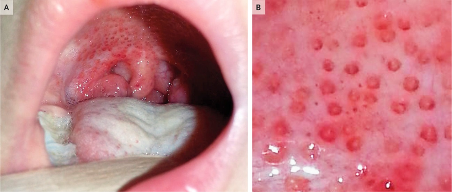 9 años♀️: dolor de garganta, fiebre, ganglios linfáticos cervicales, úvula inflamada, amígdalas agrandadas y lesiones en forma de "rosquilla" (doughnut) en el paladar duro y blando (A y B).
1/3

DOI: 10.1056/NEJMicm1810556
#pediatría #infecciosas