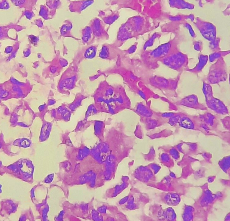 amnabruno's tweet photo. Things are getting bizarre. 🤪
#Mitosis
#SurgicalPathology #Histopathology #TwitterPath https://t.co/WDD0E15nuY