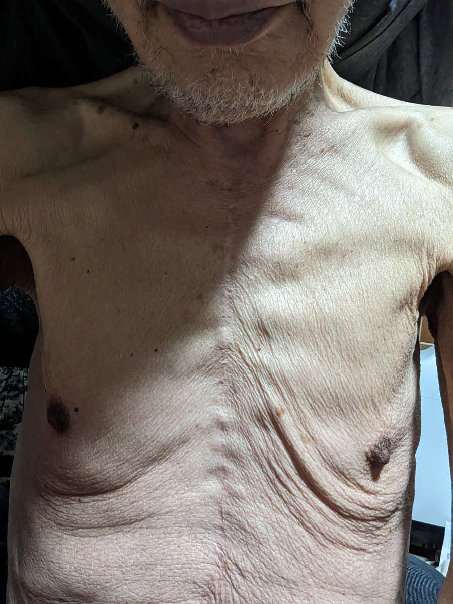 knp12eco's tweet image. 【１日に１回覗き、殺害予防に被害の周知拡散協力を:令和の叙勲者が飢餓状態？】一定の貢献認められた叙勲者で、年金生活者、申し訳無いけど、食費は何とかなっている者が、飢餓状態の体。なんで、こんなことが？…