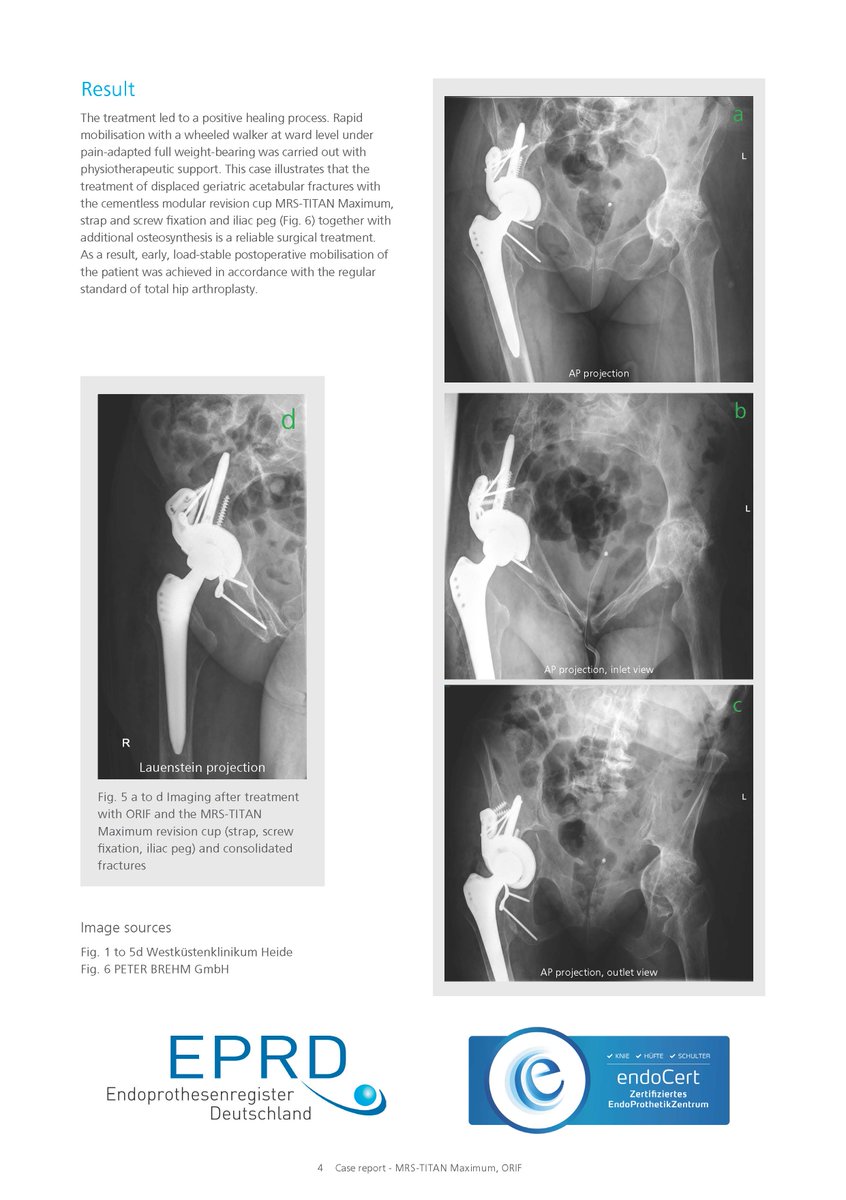 PETERBREHM_GmbH's tweet photo. Reliable treatment of a geriatric acetabular fracture with proven revision cup MRS-TITAN Maximum and additional ORIF. Early load-stable postoperative mobilisation of the patient. Request more case reports: marketing@peter-brehm.de #PETERBREHM #orthopaedics #orthopedics #revision https://t.co/T9LxhMeQfS